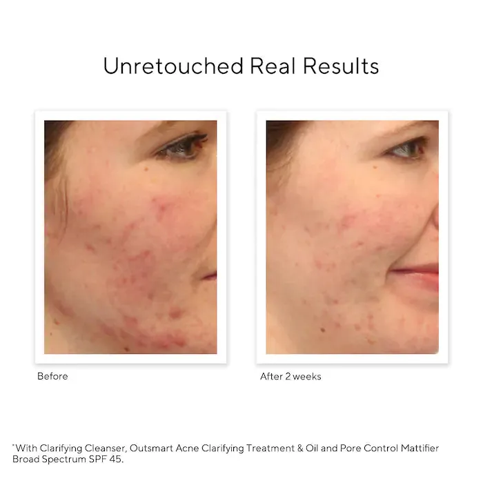 Murad Outsmart Acne Clarifying Treatment
